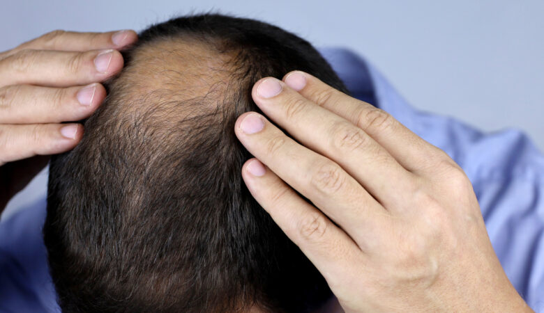 Kök Hücre ile Saç Kökü Canlandırma